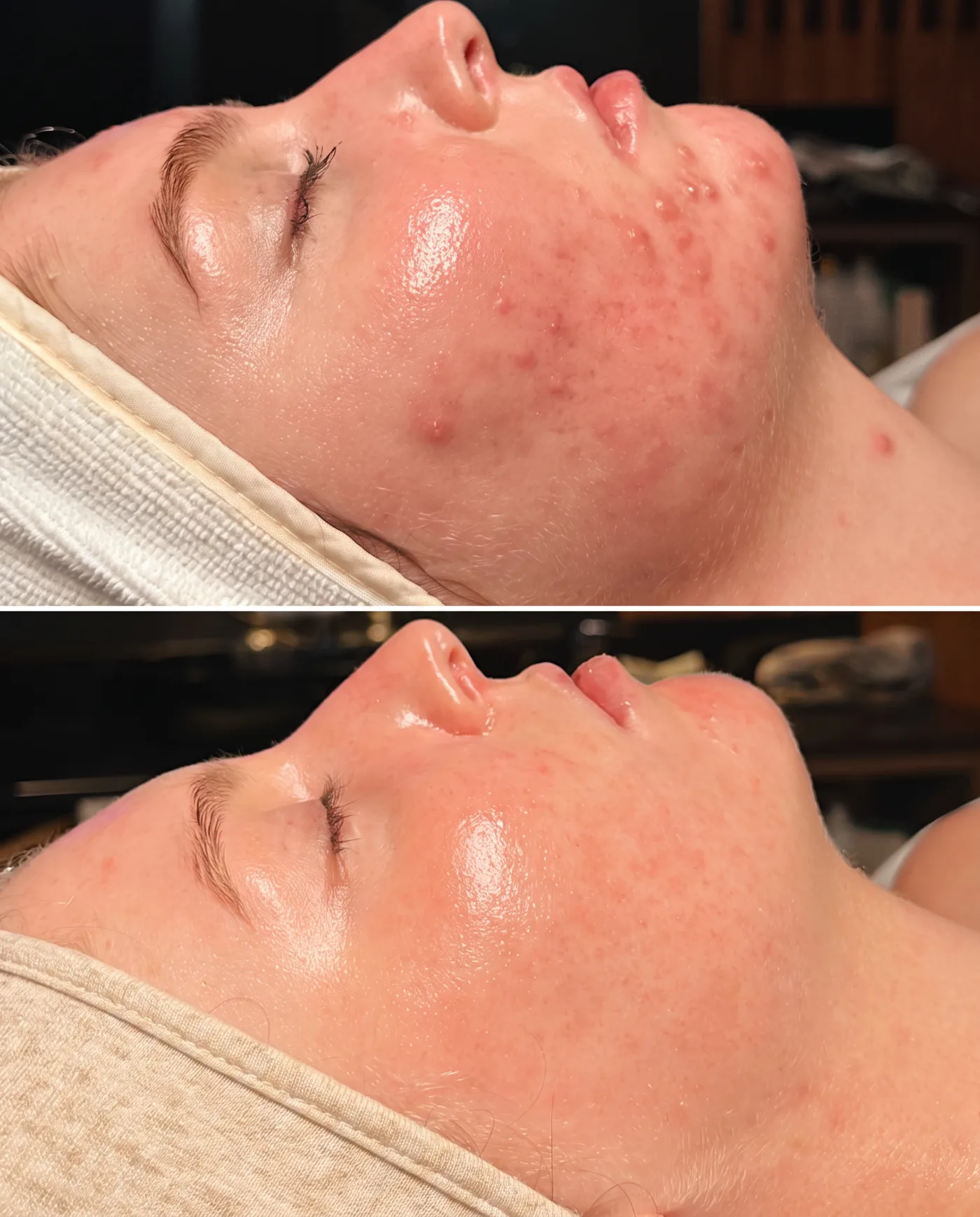 Zenko Spa guest skin progress — before and after a customized facial treatment series in Fort Lauderdale